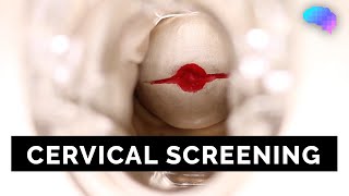 Cervical Screening SMEAR  OSCE Guide  UKMLA  CPSA [upl. by Yllop]