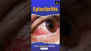 What is Episcleritis  Ophthalmology  eye ophthalmology episcleritis eye peramedical [upl. by Clary]