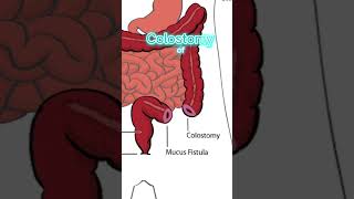 COLOSTOMY  MEDICAL DEFINITION  Medical Consecutive Interpreting [upl. by Llacam]