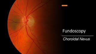 Choroidal Nevus Fundoscopy [upl. by Ajani]