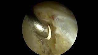 Arthroscopic Pincer Resection Utilizing an Outside In Approach for Intra articular Access [upl. by Anoed]