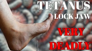 How Tetanus Can Be Very Fatal  Things to know [upl. by Niall]