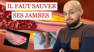 ARTÈRES des jambes BOUCHÉES et ULCÈRE de la PEAU ce quil faut savoir [upl. by Preiser855]