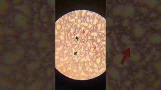 Blood smear examinationneutrophils and lymphocytesamp absolute lymphopenia observed on DLC evaluati [upl. by Baalman]