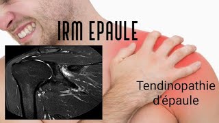 IRM DE L’EPAULE  tendinopathie [upl. by Aleacem204]