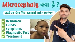 Microcephaly in Hindi  Causes Symptoms And Treatment of Microcephaly [upl. by Alaehcim172]