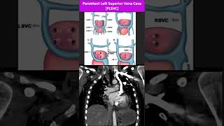 Persistent Left Superior Vena Cava [upl. by Ingalls422]