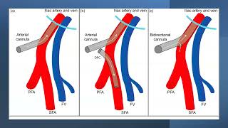 06 Cannulation by Dr Dipanjan Chatterjee ECMO INDIA OCT 2024  Day 01 [upl. by Jannel]