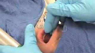 IntubationHow to perform endotracheal intubation  2 [upl. by Fogarty572]