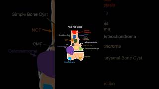 Bony Tumor animation for age more than 30 years [upl. by Ambler948]