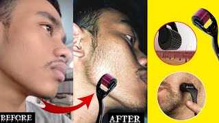 Derma roller for beard  minoxidil beard  derma roller beard growth man matters beard oil review [upl. by Chubb]