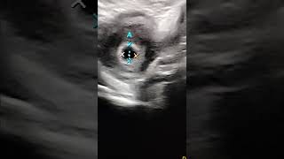 pregnancy ultrasound gestational sacGSUPT positive [upl. by Liahus]