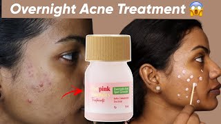 I Tried An Overnight Pimple Treatment OMG Shocking Results 😲 [upl. by Campos]