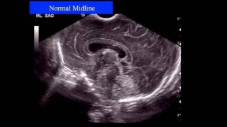 Neonatal Neurosonography The Premature Infant [upl. by Gustave331]