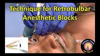 Technique for Retrobulbar Anesthetic Injection for Eye Surgery [upl. by Tripp455]