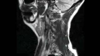 MRI scans brainneck injury abnormal full v2 [upl. by Gayleen]