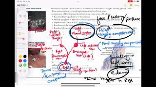 Superior Vena cava syndrome Respiratory 59  First Aid USMLE Step 1 in UrduHindi [upl. by Erialb]