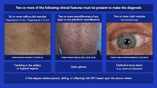 Neurofibromatosis Type 1 Clinical Diagnostic Criteria [upl. by Denna]