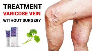 Best Medicine for Varicose vein 2023  Varicose vein Treatment without Surgery [upl. by Lodie]