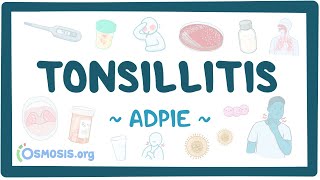 Tonsillitis Nursing Process ADPIE [upl. by Oilerua]