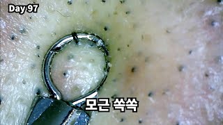 매일 뽑기 97일 차  daily hair removal day 97  모근압출  hair root extrusion [upl. by Laroy]