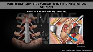 Posterior Lumbar Fusion amp Instrumentation at L3S1 [upl. by Lyckman919]