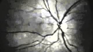 Tour of the Fundus funduscopic examination technique [upl. by Nahsrad]