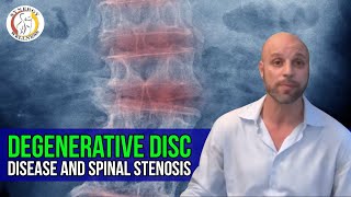 Degenerative Disc Disease and spinal stenosis 4 treatment options [upl. by Aikimat963]