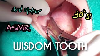 ASMR Wisdom Tooth Extraction in 1 Minute [upl. by Notyard]