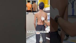 Severe spinal deformity scoliosis treatment by DrRavi scoliosis doctor chiropractor physio [upl. by Nylorak587]