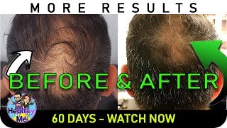 Onion Juice Hair Regrowth  New Pics  60 Days Before amp After Results [upl. by Corrinne]