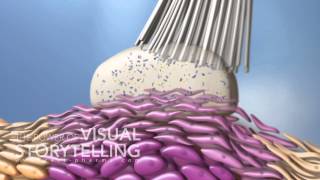 Actinic Keratosis Mode of Action Animation [upl. by Stronski358]