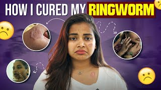 My severe skin allergy update Ringworm வந்தா இத பண்ணுங்க  Keerthi Shrathah [upl. by Hildegaard715]