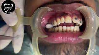 CLASS 2 DIV 1  BRACES  ORTHODONTICS  ANANTNAG trending braces dentist imrankhan [upl. by Weinert]