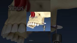 Sinus Lift Surgery 3D Animation [upl. by Parrnell409]