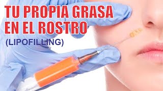 LIPOFILLING o LIPOTRANSFERENCIA al ROSTRO 👸🏻 Tu propia GRASA en el rostro ❤️ Dra LIZBETH ZUÑIGA [upl. by Assirok]