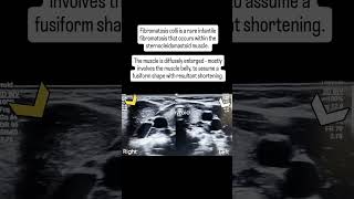 Fibromatosis colli radiology [upl. by Noswal34]