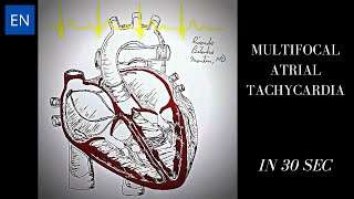 Multifocal Atrial Tachycardia Animation and ECG Shorts [upl. by Attiuqal]