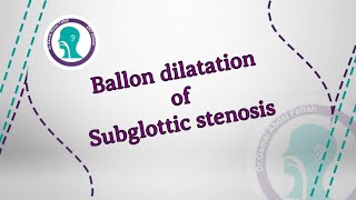 Ballon dilatation of subglottic stenosis [upl. by Lielos69]