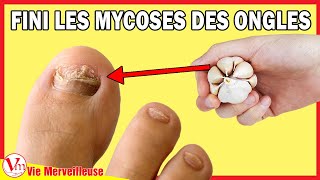 Comment Enlever Les Mycoses Des Ongles Des Pieds Avec L’ail  Remède À La Maison [upl. by Betty]