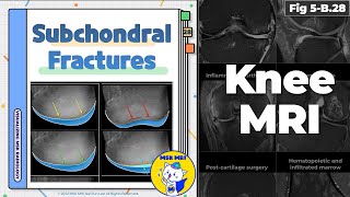 Fig 5B28 Four Types of Subchondral Insufficiency Fractures [upl. by Akinyt]