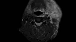 Masticator space abscess A Ahuja AT et al 2017 Book Essential Radiology [upl. by Britta259]