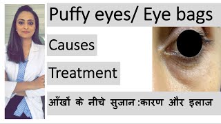 puffy eyes eye bags aankhon ke neeche sujan  कारण और इलाज  Dr Aanchal  dermatologist [upl. by Bently]