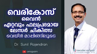 വെരികോസ് വെയ്ൻ ഏറ്റവും ഫലപ്രദമായ ചികിത്സ  Varicose veins Treatment in Malayalam Dr Sunil Rajendran [upl. by Molahs]