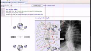 Cobb Angle Measurement [upl. by Westland]