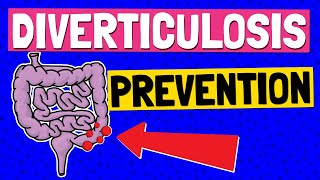 Diverticulosis TREATMENT amp PREVENTION 🍴 Which FOODS to EAT and AVOID [upl. by Montagu]