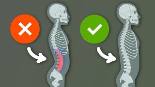 Lordosis Do THIS for a straighter posture Hyperlordosis ✔ [upl. by Broderic]