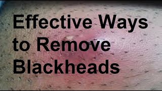 Effective Ways to Remove Blackheads [upl. by Dihahs563]