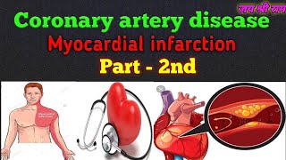 Myocardial infarction part2 [upl. by Haidabez]