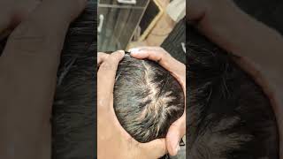 Skin hair patch for mans hairextensions hairpieces hairwigservicesingurgaon [upl. by Asabi546]